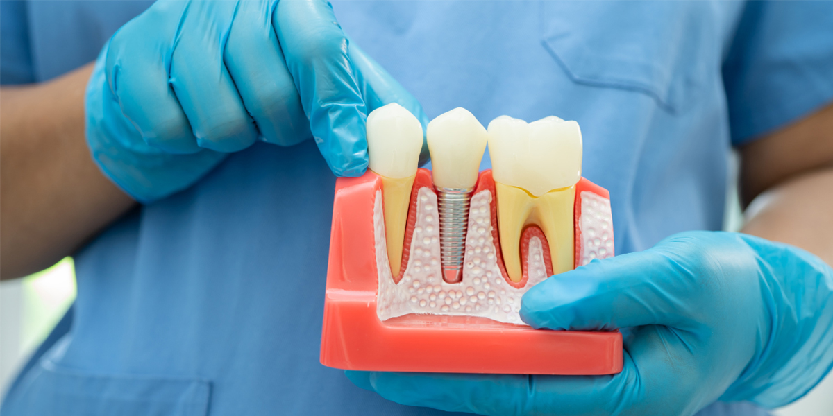 dental implants treatment options at Erin Mills Smiles Dentistry