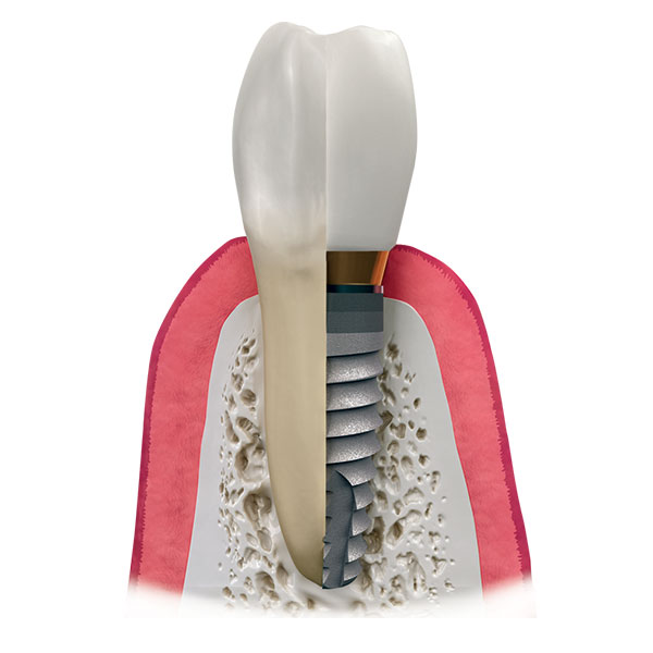dental-implants-2