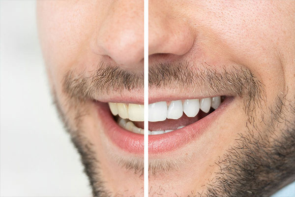 panel-teeth-whitening